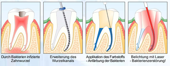 laser info